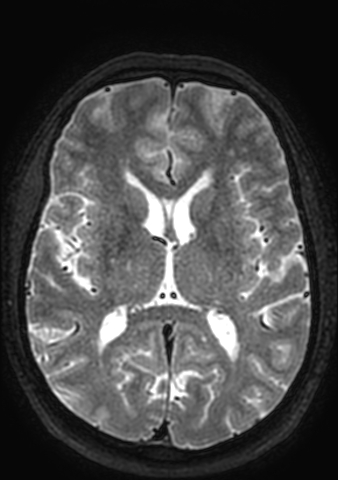 Accessory middle cerebral artery (Radiopaedia 73114-83828 Axial T2 59).jpg