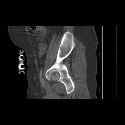 File:Acetabular fracture (Radiopaedia 13193-13212 Sagittal bone window 26).jpg