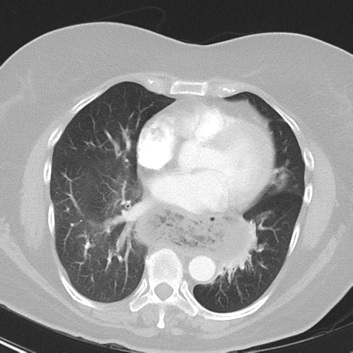 File:Achalasia (Radiopaedia 47147-51685 Axial lung window 30).png
