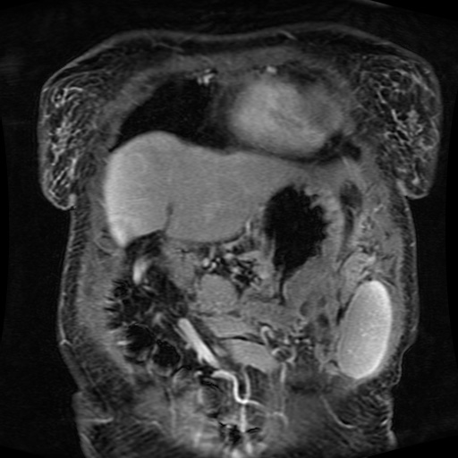 Acinar cell carcinoma of the pancreas (Radiopaedia 75442-86668 Coronal T1 C+ fat sat 152).jpg