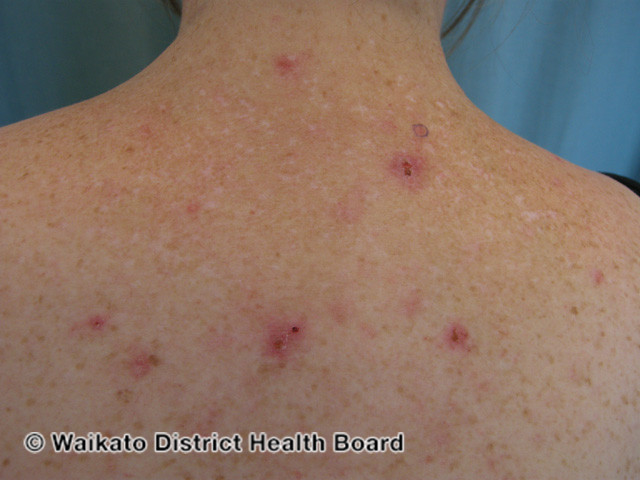 File:Acne urticata (DermNet NZ acne-w-acne-urticata-2).jpg