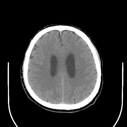 File:Acoustic schwannoma (Radiopaedia 29488-29982 AXIAL THICK non-contrast 34).jpg