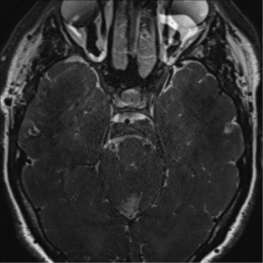 File:Acoustic schwannoma (Radiopaedia 50846-56358 Axial T2 36).png