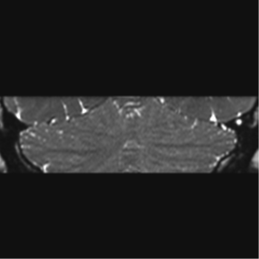 File:Acoustic schwannoma (Radiopaedia 50846-56358 Coronal T2 1).png