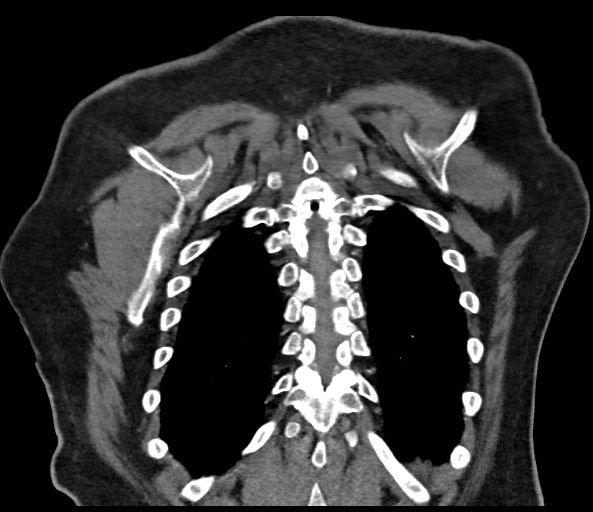 File:Acromioclavicular joint cyst (Radiopaedia 58455-65610 Coronal C+ arterial phase 120).jpg