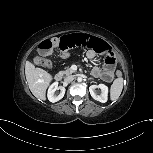 Active Crohn disease (Radiopaedia 59394-66750 Axial C+ portal venous phase 27).jpg