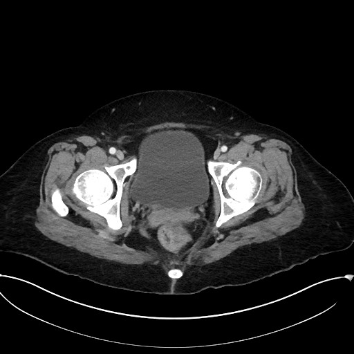 Active Crohn disease (Radiopaedia 59394-66750 Axial C+ portal venous phase 68).jpg