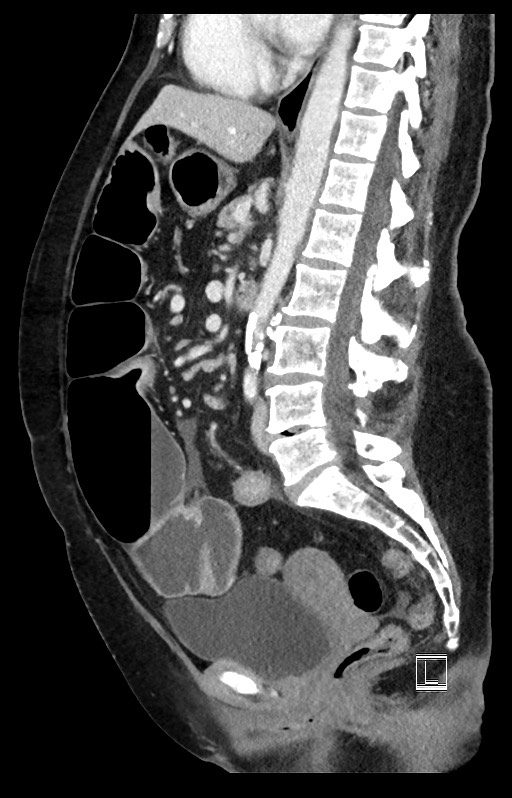 Active Crohn disease (Radiopaedia 59394-66750 Sagittal C+ portal venous phase 28).jpg