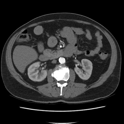 File:Active colonic bleed on CT (Radiopaedia 49765-55025 Axial C+ arterial phase 35).jpg