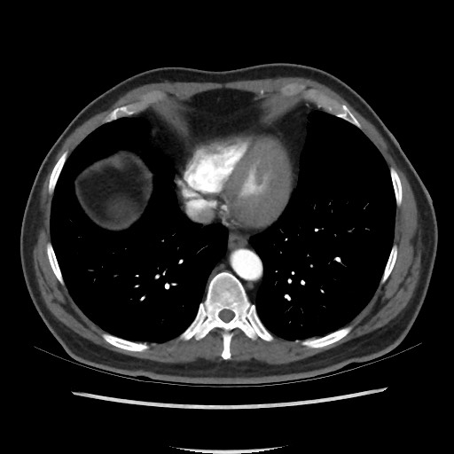 Active colonic bleed on CT (Radiopaedia 49765-55025 Axial C+ arterial phase 6).jpg