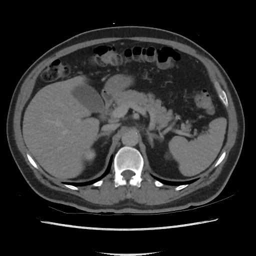 File:Active colonic bleed on CT (Radiopaedia 49765-55025 Axial C+ delayed 24).jpg