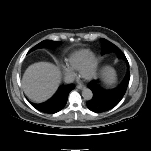 Active colonic bleed on CT (Radiopaedia 49765-55025 Axial non-contrast 2).jpg