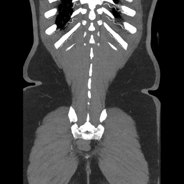 Active colonic bleed on CT (Radiopaedia 49765-55025 Coronal art MIP 54).jpg