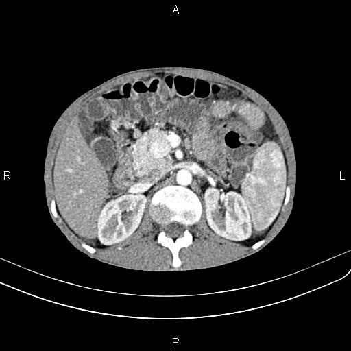 Active crohn disease (Radiopaedia 87133-103397 Axial C+ arterial phase 38).jpg