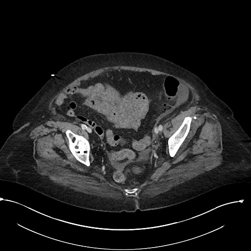 File:Active renal extravasation with large subcapsular and retroperitoneal hemorrhage (Radiopaedia 60975-68796 Axial 296).jpg
