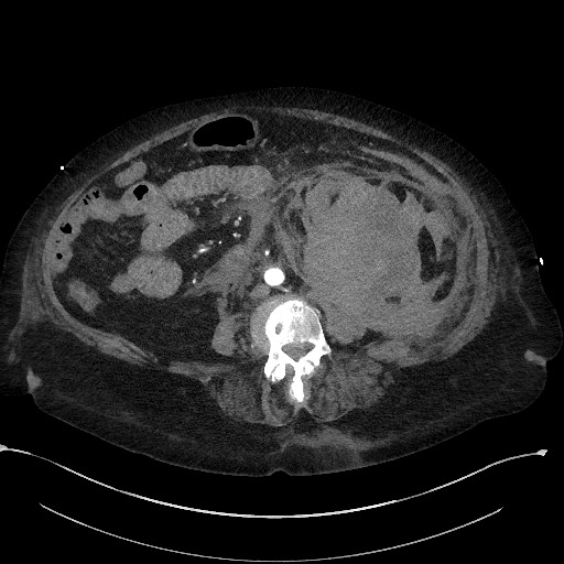 File:Active renal extravasation with large subcapsular and retroperitoneal hemorrhage (Radiopaedia 60975-68796 Axial C+ arterial phase 107).jpg