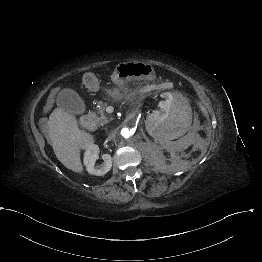 Active renal extravasation with large subcapsular and retroperitoneal hemorrhage (Radiopaedia 60975-68796 Axial C+ arterial phase 75).jpg