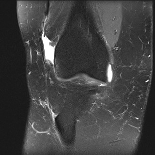 File:Acute-on-chronic transient lateral patellar dislocation with trochlear dysplasia (Radiopaedia 84099-99349 Coronal PD fat sat 27).jpg