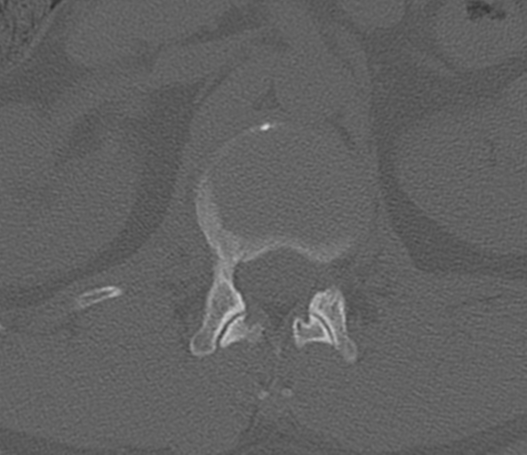 File:Acute L1 burst compression fracture (Radiopaedia 34430-35755 Axial bone window 18).png