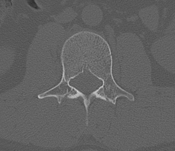 File:Acute L1 burst compression fracture (Radiopaedia 34430-35755 Axial bone window 35).png