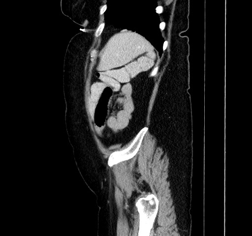 Acute appendicitis, heterotaxy syndrome (Radiopaedia 66884-76202 Sagittal C+ portal venous phase 109).jpg