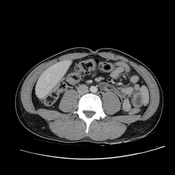 Acute appendicitis (Radiopaedia 27049-27227 Axial C+ portal venous phase 40).jpg