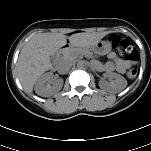 Acute appendicitis (Radiopaedia 30261-30888 Axial non-contrast 18).jpg