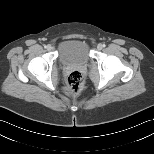 Acute appendicitis (Radiopaedia 30297-30934 Axial C+ portal venous phase 79).jpg