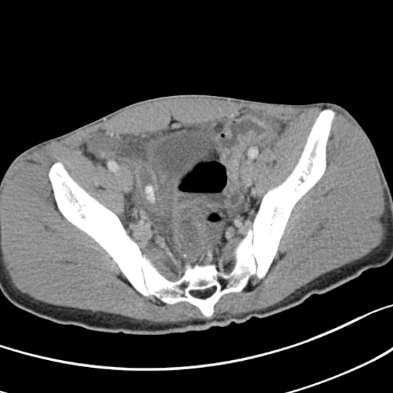 File:Acute appendicitis (Radiopaedia 32614-33572 Axial C+ portal venous phase 55).jpg