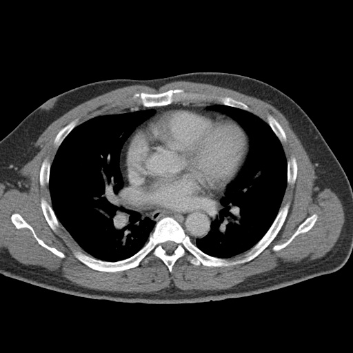 Acute appendicitis (Radiopaedia 48511-53463 Axial C+ portal venous phase 2).jpg