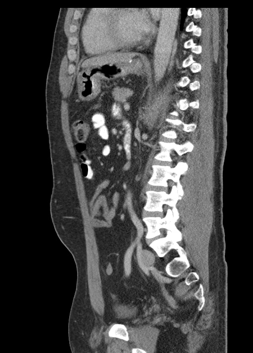 Acute appendicitis (Radiopaedia 48511-53463 Sagittal C+ portal venous phase 80).jpg