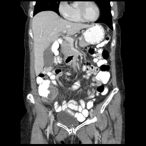 Acute appendicitis (Radiopaedia 52672-58589 Coronal C+ portal venous phase 29).jpg