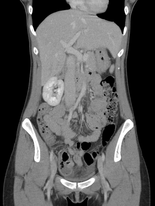 Acute appendicitis (Radiopaedia 62608-70901 Coronal C+ portal venous phase 16).jpg