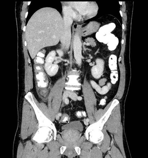 File:Acute appendicitis (Radiopaedia 77016-88960 Coronal C+ portal venous phase 54).jpg