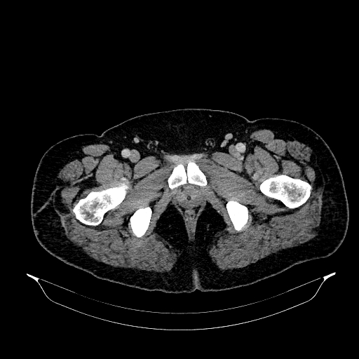 Acute appendicitis (Radiopaedia 79950-93224 Axial C+ portal venous phase 103).jpg