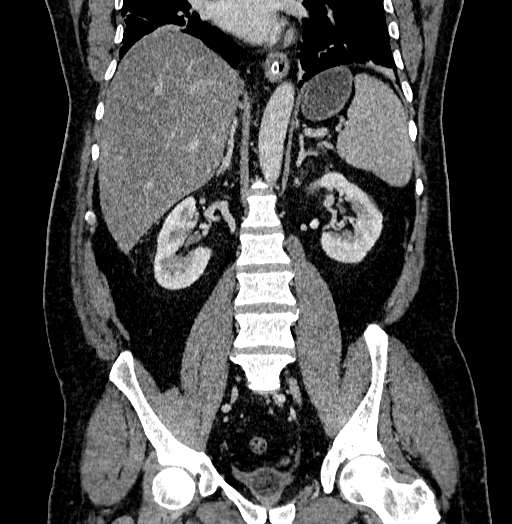 Acute appendicitis (Radiopaedia 79950-93224 Coronal C+ portal venous phase 57).jpg