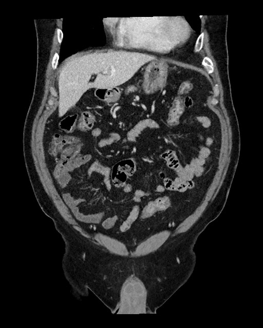 Acute appendicitis - large appendicoliths (Radiopaedia 61805-69820 Coronal C+ portal venous phase 40).jpg