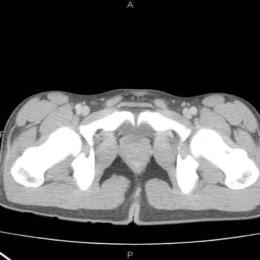 File:Acute appendicitis with CT arrowhead sign (Radiopaedia 21474-21411 Axial C+ portal venous phase 41).jpg
