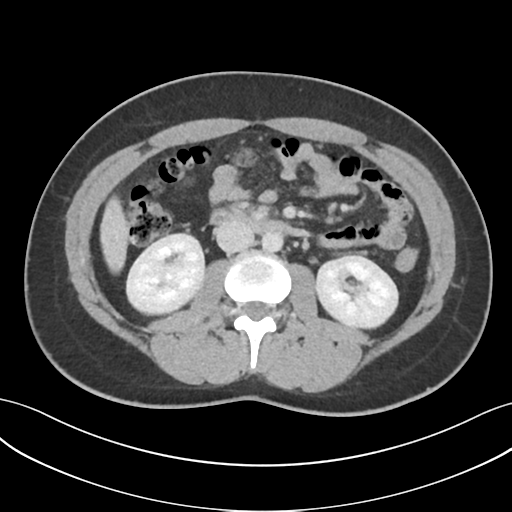 Acute appendicitis with appendicoliths (Radiopaedia 50186-55532 Axial C+ portal venous phase 36).png