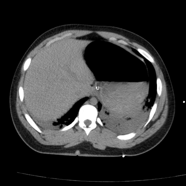 Acute aspiration pneumonitis (Radiopaedia 33605-34703 Axial non-contrast 73).jpg