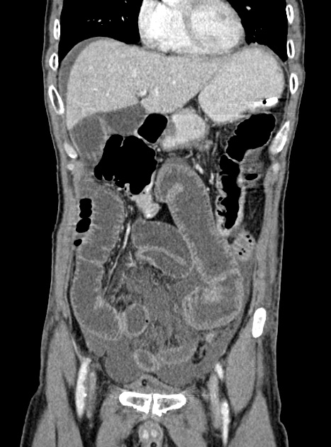 Acute bowel ischemia (Radiopaedia 87695-104114 Coronal C+ portal venous phase 145).jpg