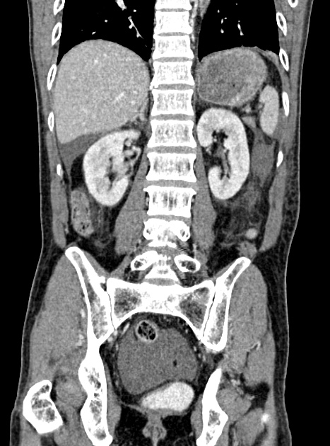 Acute bowel ischemia (Radiopaedia 87695-104114 Coronal C+ portal venous phase 266).jpg