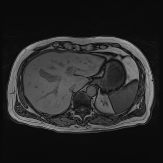 File:Acute cholecystitis (Radiopaedia 72392-82923 Axial T1 out-of-phase 35).jpg