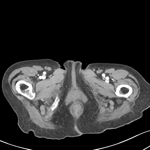 File:Acute cholecystitis with contained perforation (Radiopaedia 47328-51907 Axial C+ portal venous phase 82).png