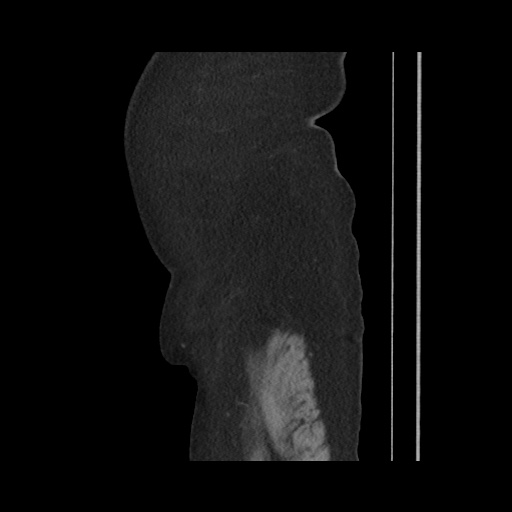 Acute cholecystitis with tensile fundus sign (Radiopaedia 71394-81723 Sagittal non-contrast 28).jpg