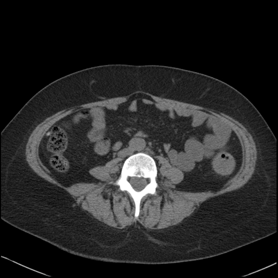 Acute colonic hemorrhage in ulcerative colitis (Radiopaedia 77415-89538 Axial non-contrast 80).jpg