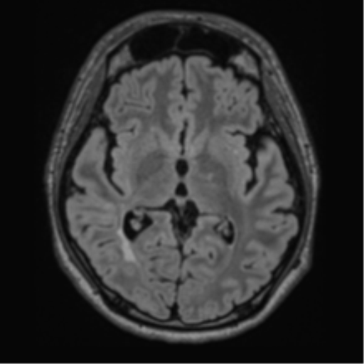 Acute disseminated encephalomyelitis (ADEM)- Anti-NMDA receptor encephalitis (Radiopaedia 54920-61201 Axial FLAIR 33).png