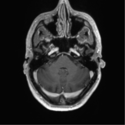 Acute disseminated encephalomyelitis (ADEM) (Radiopaedia 65319-74350 Axial T1 C+ 10).png