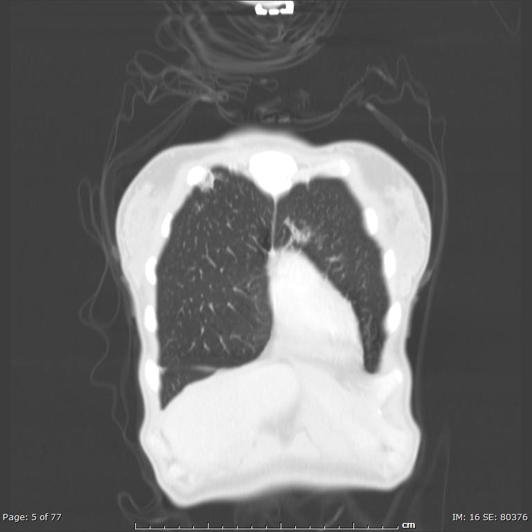 Acute eosinophilic pneumonia (Radiopaedia 48211-53073 Coronal lung window 2).jpg
