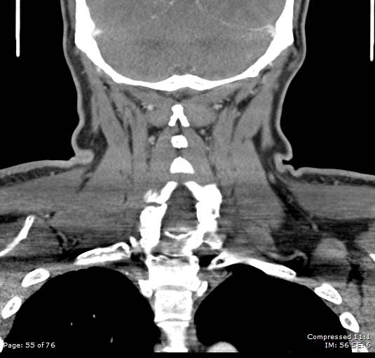 Acute epiglottitis (Radiopaedia 54375-60590 Coronal C+ arterial phase 55).jpg